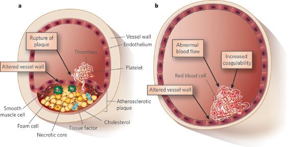 Tromboza arterija