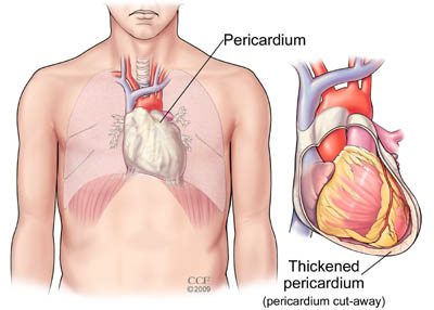 Pericarditis – Zapaljenje spoljašnje srčane opne
