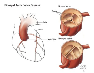 Oboljenje aortinih zalizaka