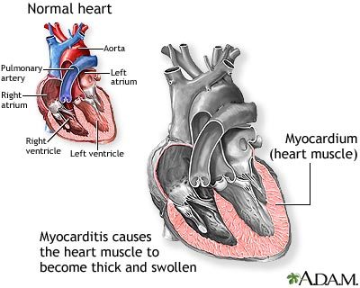 Miokarditis – Hronična slabost srčanog mišića