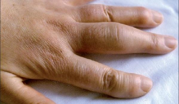 Gnojno zapaljenje na prstima usled povrede i infekcija na rukama