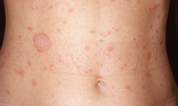 Kožna bolest koprivnjača - osip po telu kod dece i odraslih